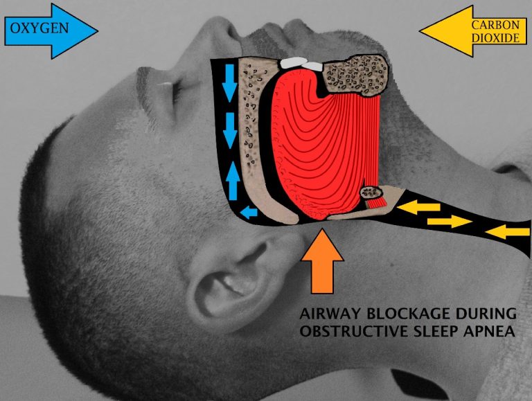 The Effects of Sleep Apnea on the Body DIY Morning